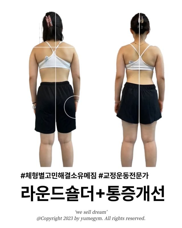 라운드숄더+통증개선
