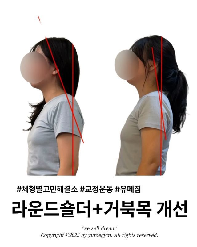 라운드숄더+거북목 개선