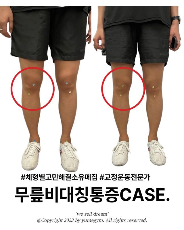 무릎비대칭통증 CASE
